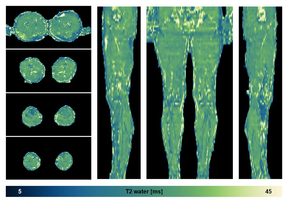 The water only T2 relaxation time of the lower extremity obtained from multi echo spin echo t2 mapping with EPG based reconstruction.